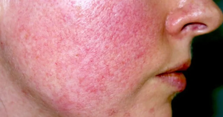 Rosácea: Entenda os Sintomas e a Importância do Tratamento