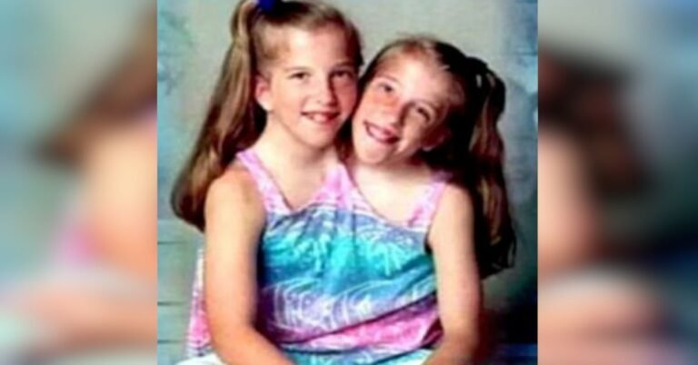 Gêmeas Siamesas que Encantaram os Anos 90: Uma História de Superação e Amor